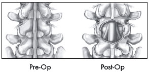 illustration “unroofing” the spine